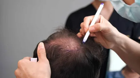 Common Myths About Hair Transplants Debunked